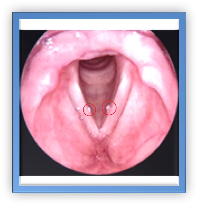 What is a throat nodule?